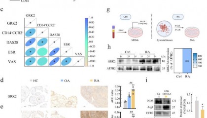 LabEx多因子检测平台助力类风湿性关节炎研究