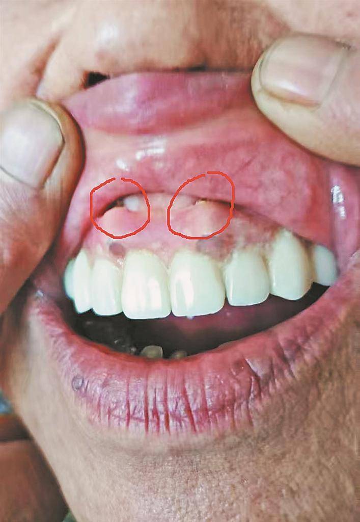 绥化刘先生反映其母亲种牙后,牙龈鼓俩大包,顶嘴唇!哈尔滨市优诺口腔回应